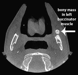 bony mass in left buccinator muscle