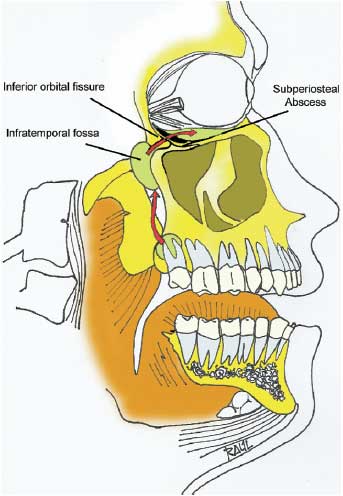 It is possible to have an epidural abscess which is caused by an 