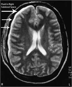 subdural empyema