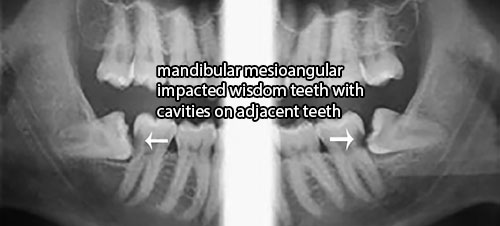 mandibular mesioangular impacted wisdom teeth cavity adjacent molar - Does Not Treating Asymptomatic Wisdom Teeth Cause Harm?