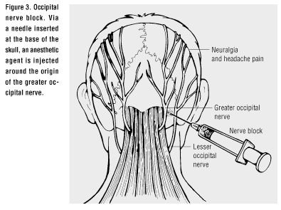 nerve block - Occipital Nerve Block for Headaches