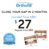 how to close gaps in teeth