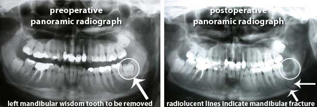 panoramic radiograph showing mandible fracture