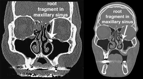 root fragment maxillary sinus