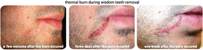 thermal burn during wisdom teeth removal