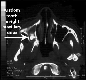 wisdom tooth in maxillary sinus