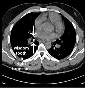 wisdom tooth in right bronchus