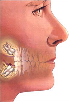 wisdom teeth