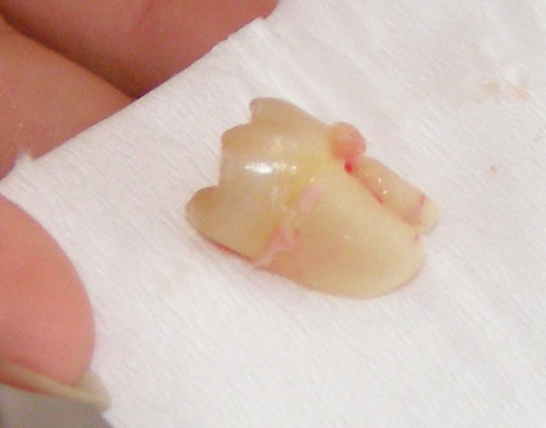 extracted wisdom tooth