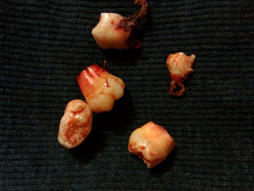 bloody bits wisdom teeth