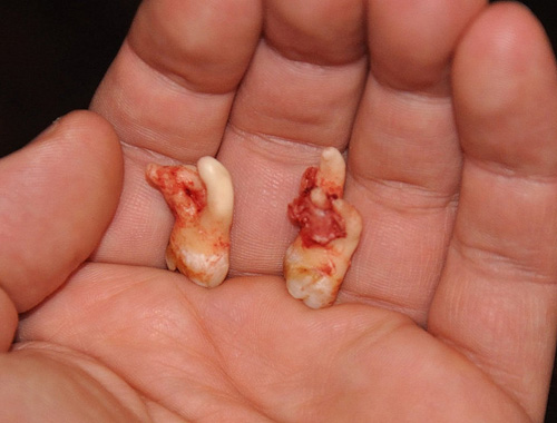 bloody wisdom teeth in hand