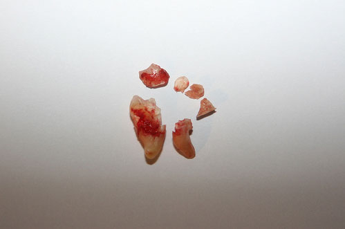 broken widom teeth fragments