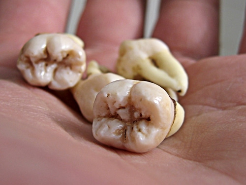 close up four wisdom teeth