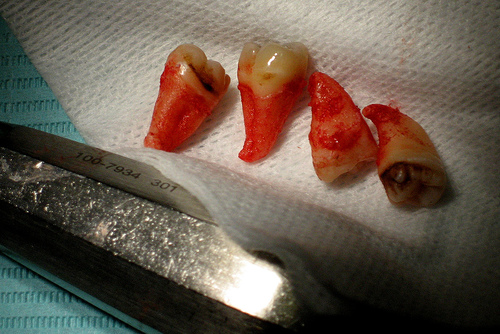 crowding mandibular eviction