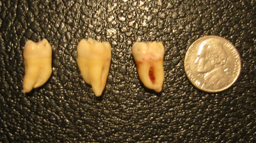 curled wisdom teeth