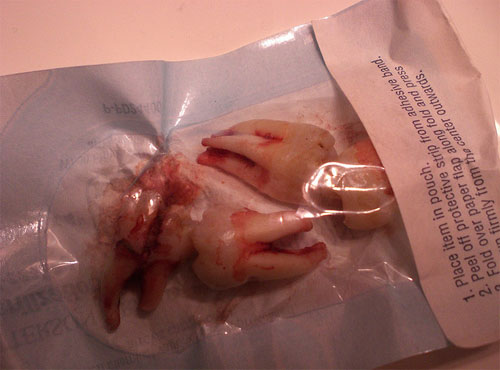 extracted wisdom teeth in bag