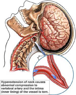 hearing loss tooth extraction