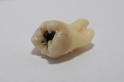 maxillary third molar