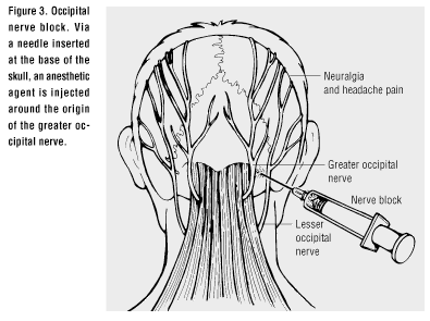 nerve block