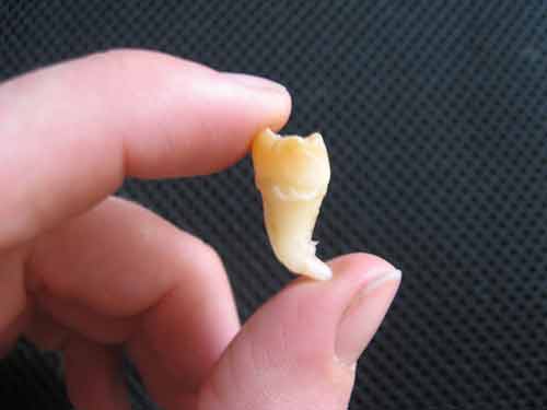 one wisdom tooth in hand