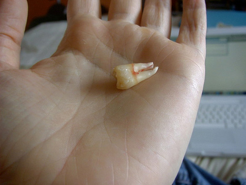 wisdom tooth taken out