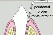 periodontal probe depth