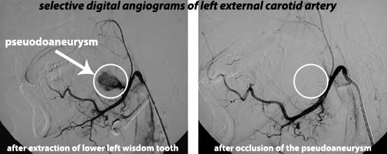 pseudoaneurysm proximal facial artery