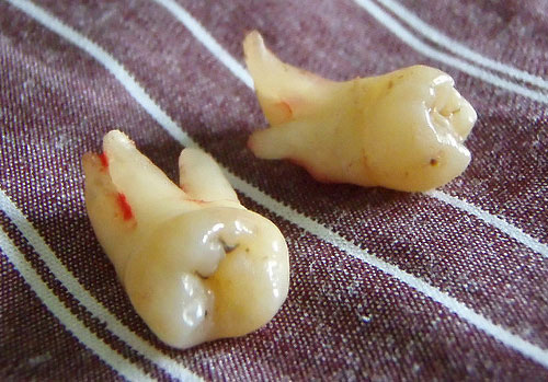 removal of wisdom teeth