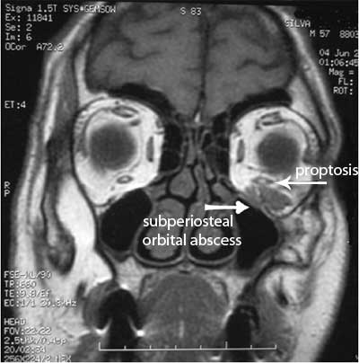 subperiosteal orbital abscess