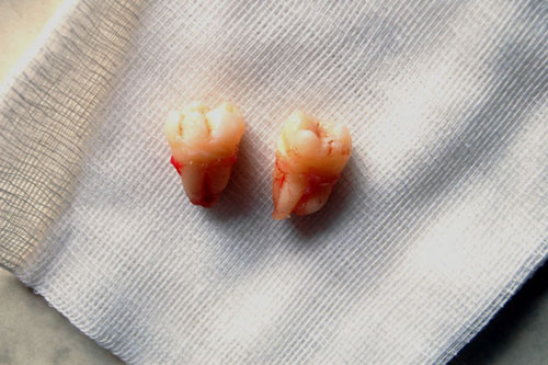 third molar