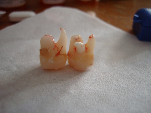 two wisdom teeth