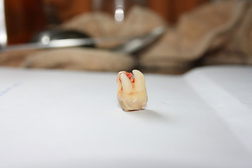 upside down wisdom tooth