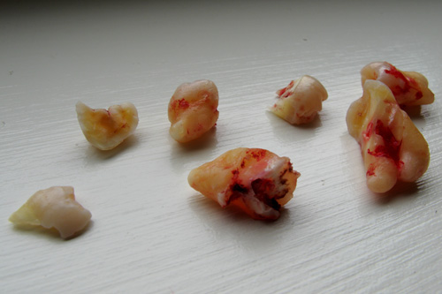 wisdom teeth brutal extraction