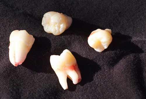 wisdom teeth image