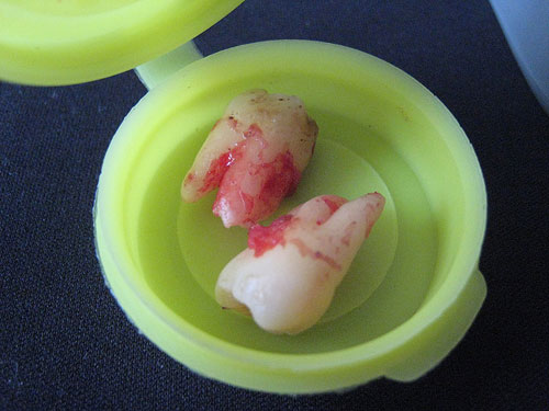 wisdom teeth in container