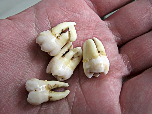 wisdom teeth hand