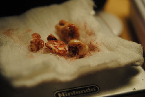 wisdom teeth nintendo