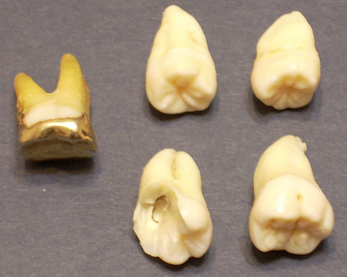 wisdom teeth dental gold