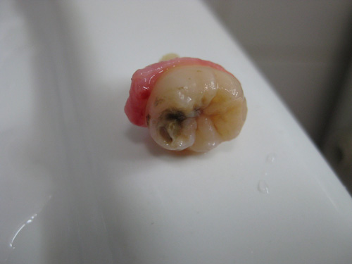 wisdom tooth extracted