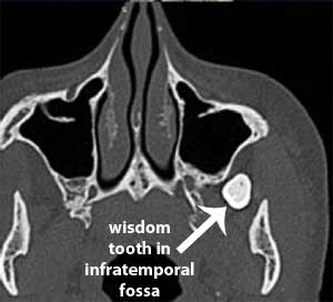 wisdom tooth in infratemporal fossa