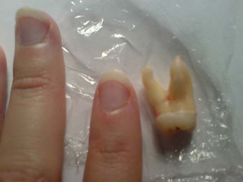 wisdom tooth next to fingers