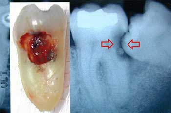 wisdom tooth x-ray